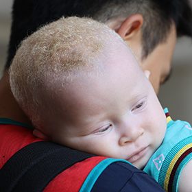 탄자니아의 알비노 환아